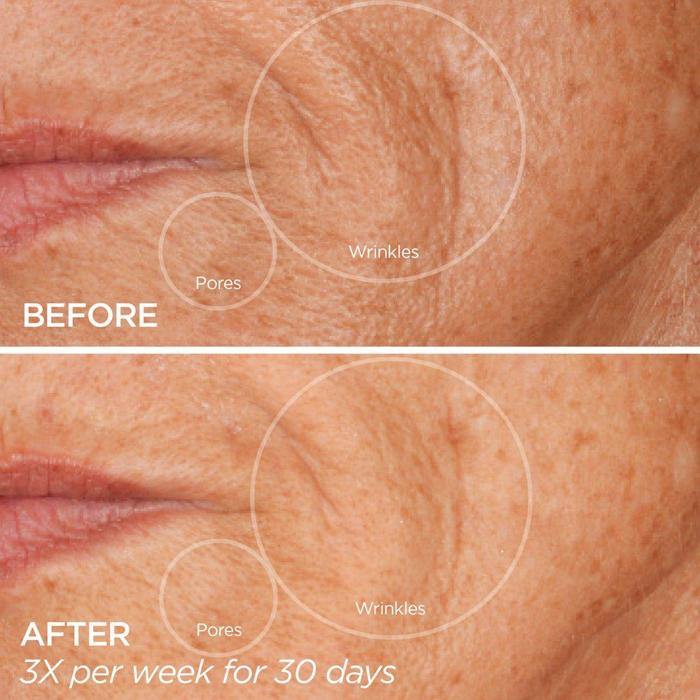 Before and after comparison of skin with wrinkles and pores, showing results from a skincare routine.
