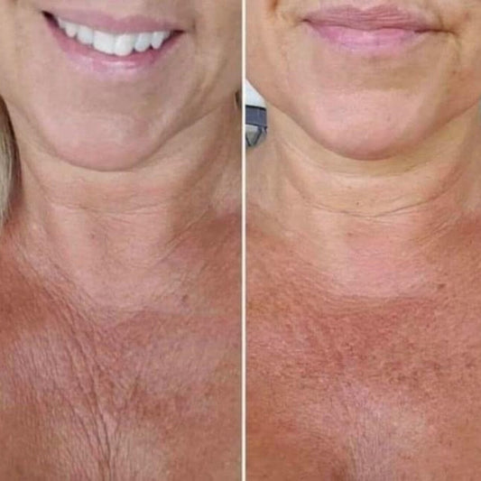 Nu Skin AgeLOC Dermatic Effects Before After