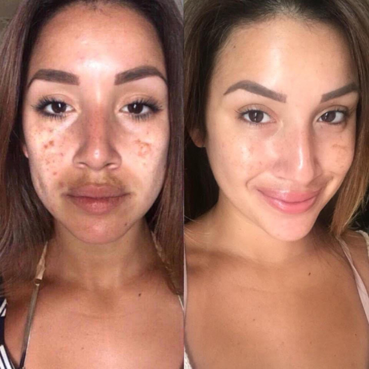 Before and after comparison of a woman's face with visible skin improvement.