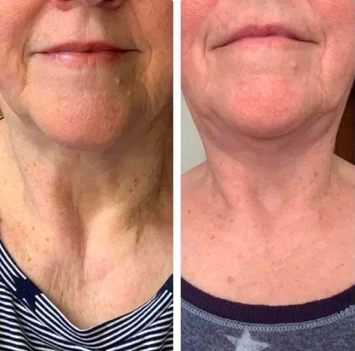 Nu Skin ageLOC Dermatic Effects | Creme Anti-Celulite e Reafirmante Corporal