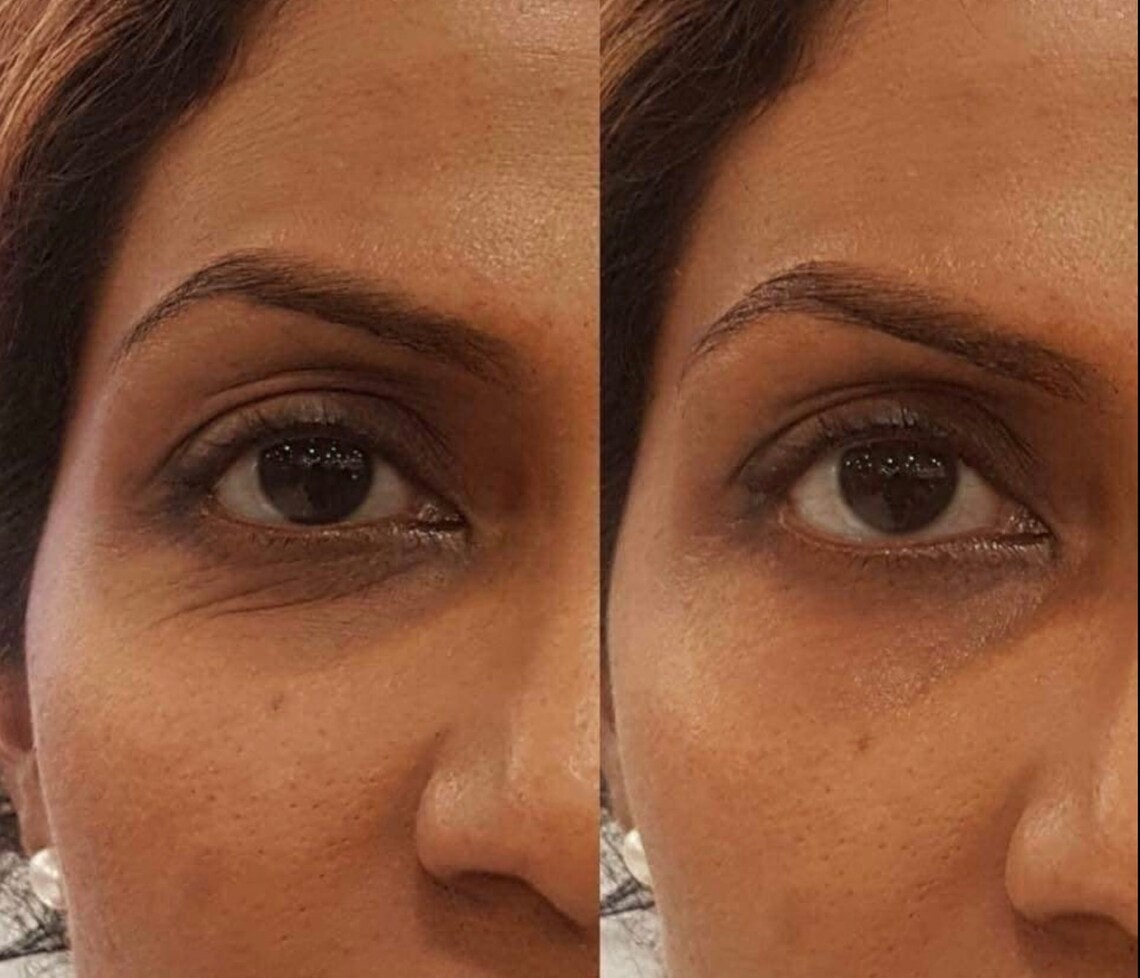 ageLOC LumiSpa iO Rose Gold Accent + IdealEyes Kit