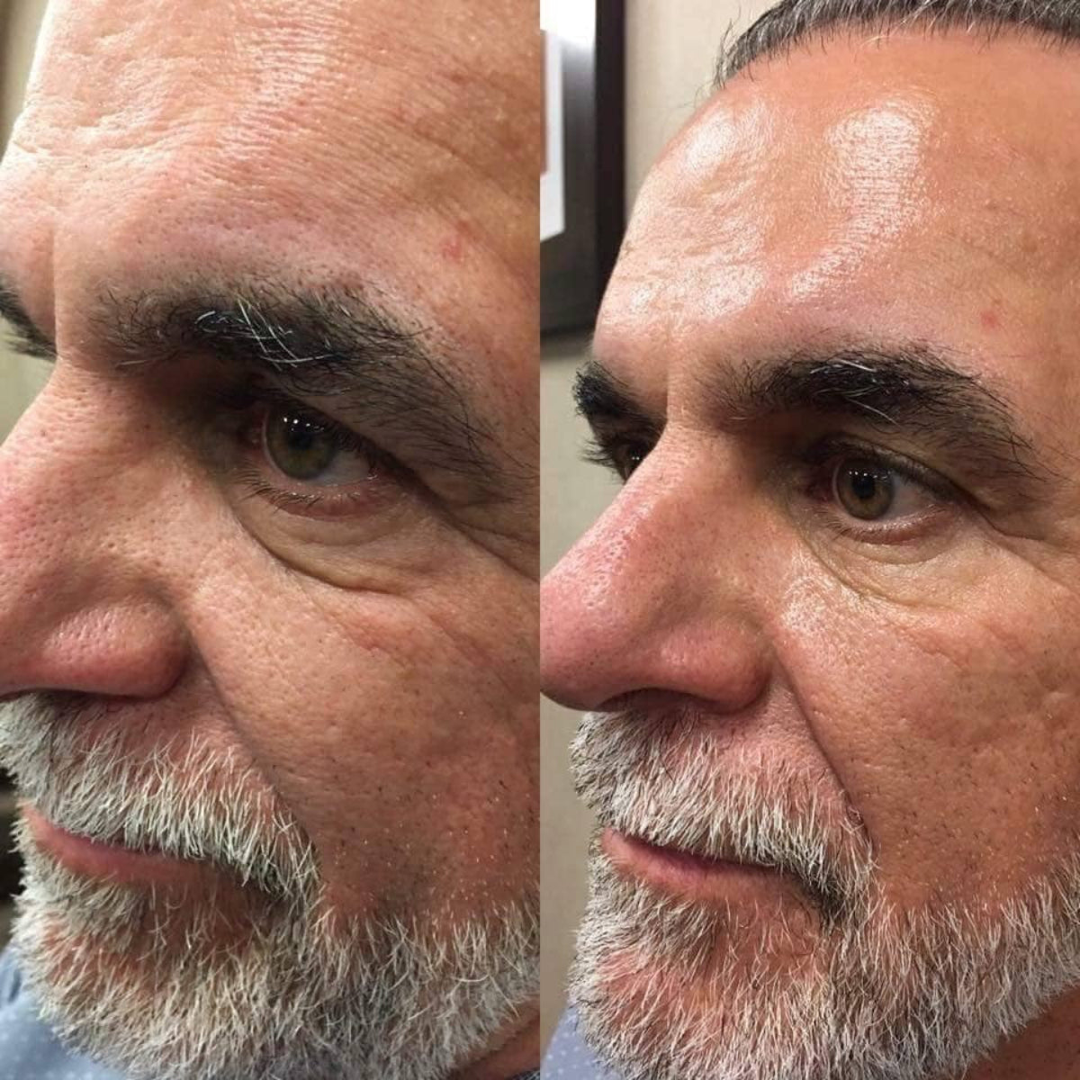 Side-by-side comparison of a man's face with and without a treatment, showing before and after effects.