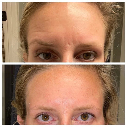 AgeLOC TruFace Line Corrector Results 2