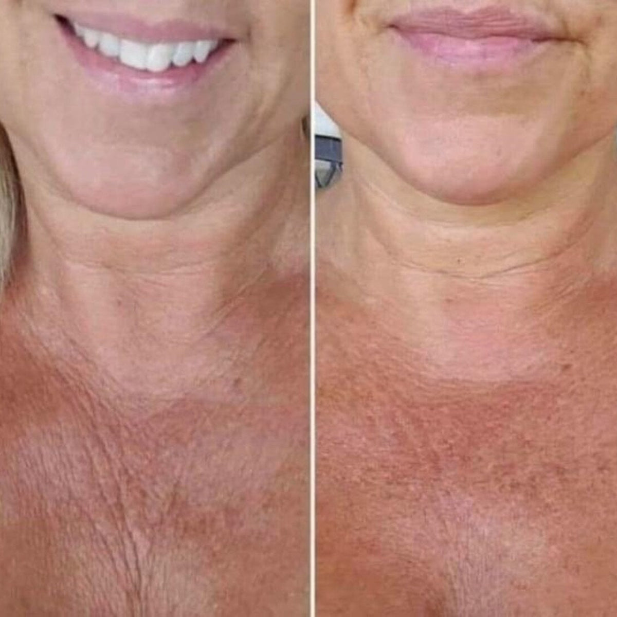 Nu Skin AgeLOC Dermatic Effects Before After