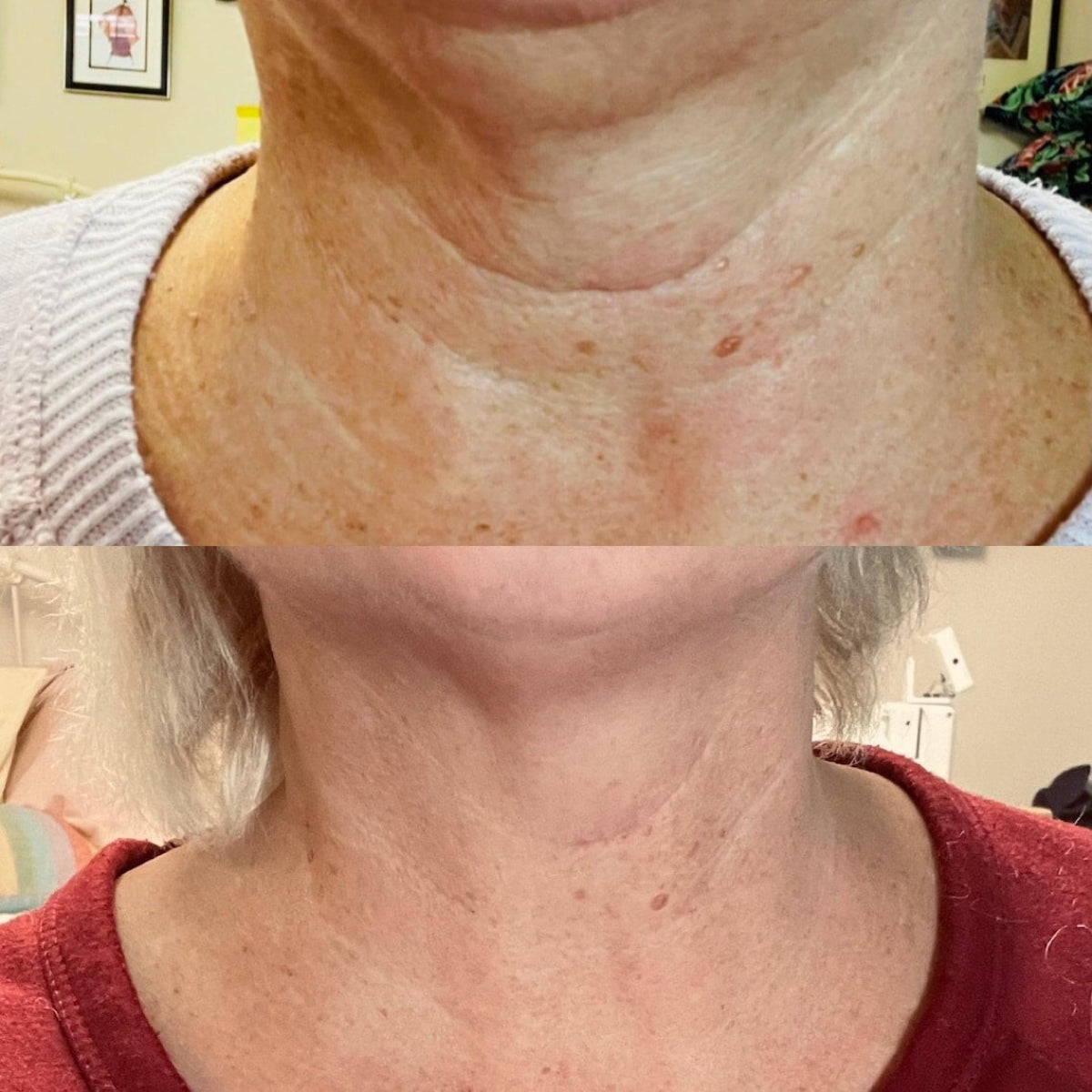 Nu Skin AgeLOC Dermatic Effects Before After 2