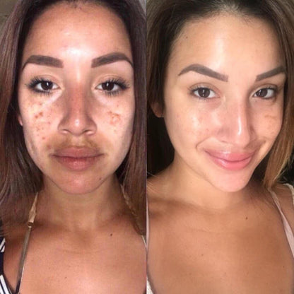 Before and after comparison of a woman's face with visible skin improvement.