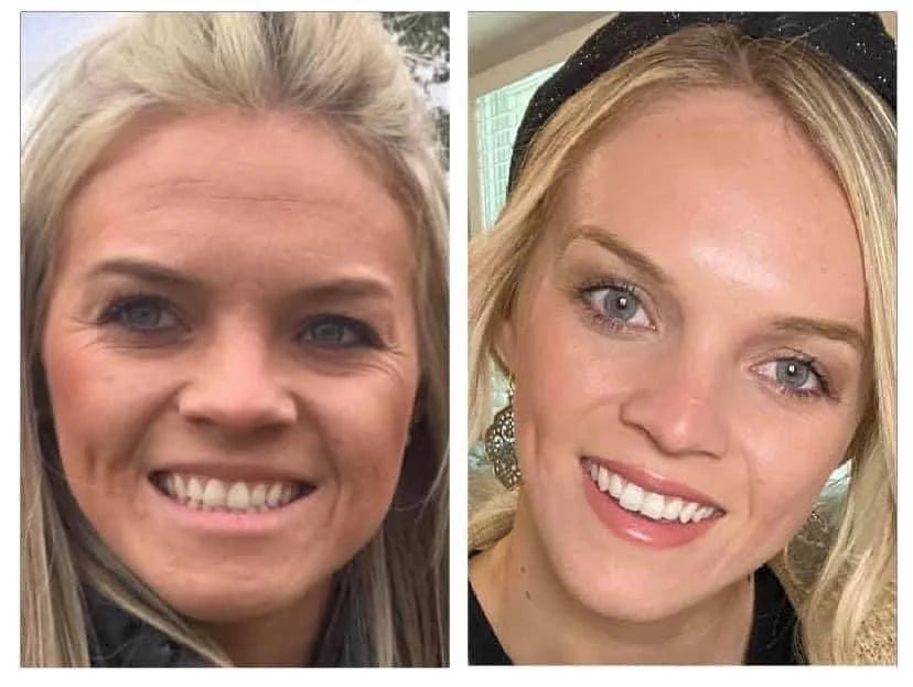 Side-by-side comparison of a woman before and after lumispa