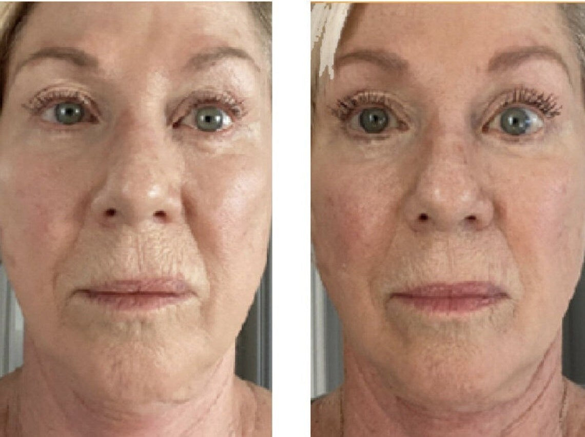 Beauty Focus Collagen Results Before And After 1