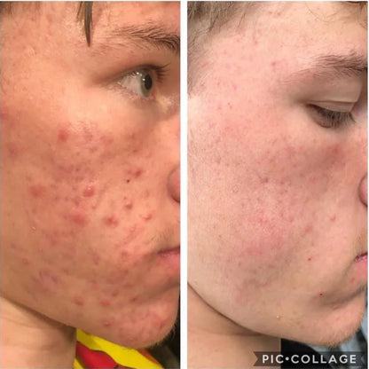 Before and after comparison of acne on a person's face.