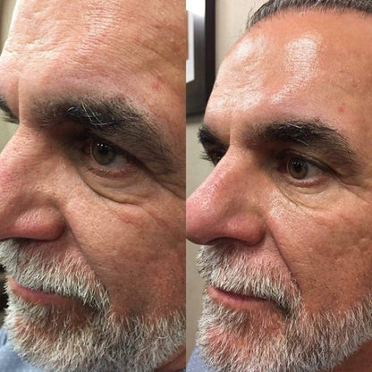 Side-by-side comparison of a man's face with and without a treatment, showing before and after effects.