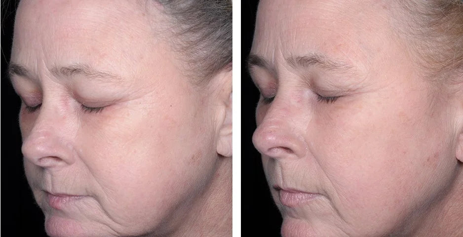 Beauty Focus Collagen before and after results